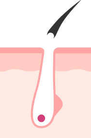 エステ脱帽のイメージ図